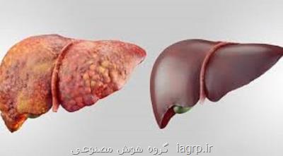 محقق ایرانی ژن اثرگذار در بیماری کبد چرب را شناسایی کرد