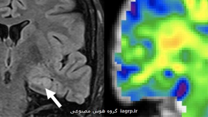 تشخیص صرع با بهره گیری از روش الاستوگرافی تشدید مغناطیسی